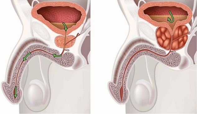 Healthy and wound prostate