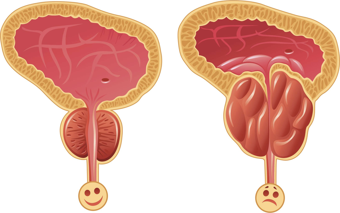 How to determine the existence of the prostatitis