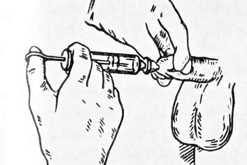 instillation for prostatitis