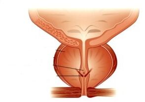 prostatitis and its treatment with drugs